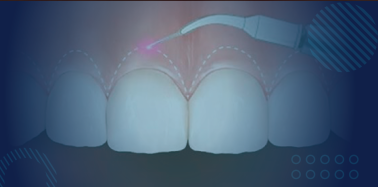 Gum Contouring (per tooth)