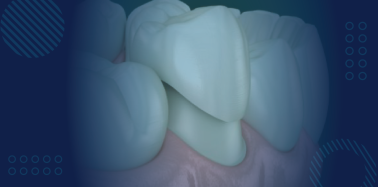 Temporary Crown (long term use)