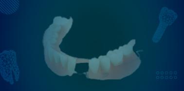 Partial Denture, Acrylic Frame