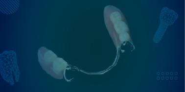 Partial Denture, Metal Frame