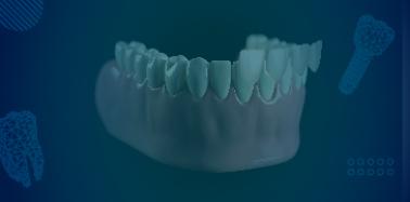 Zirconia Veneer