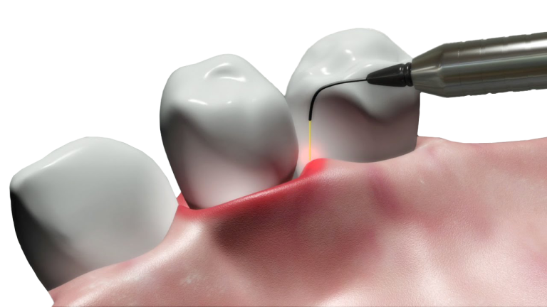 Laser dentistry Technology